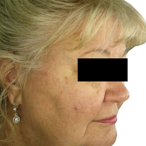 Pigmentation and redness IPL