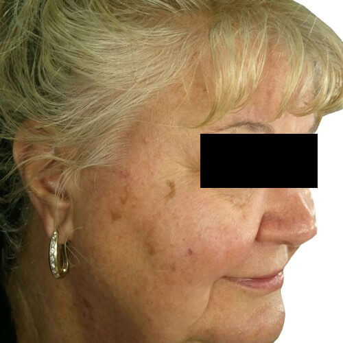 Pigmentation and redness IPL