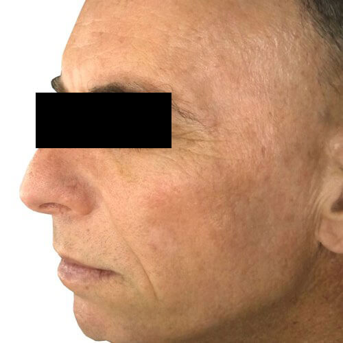 Pigmentation and redness IPL