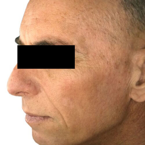 Pigmentation and redness IPL