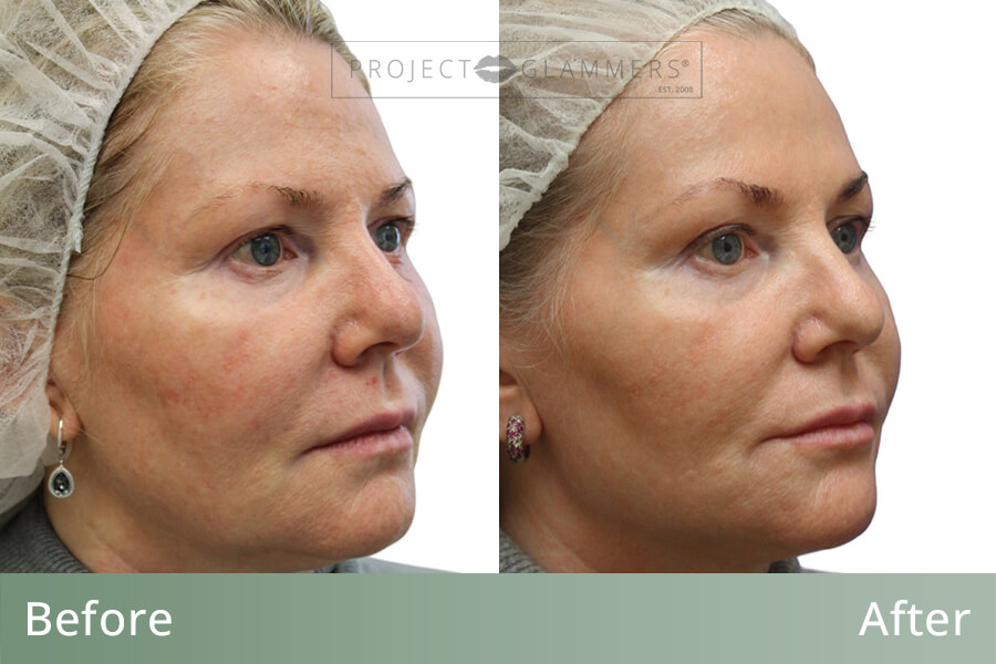 Facial Contouring Naples