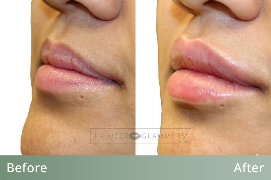 Lip Contouring Naples