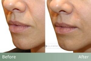 PG_BAs_Template_SmileLines