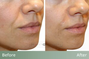 PG_BAs_Template_SmileLines2