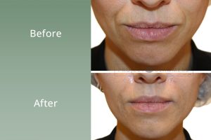 PG_BAs_Template_SmileLines3