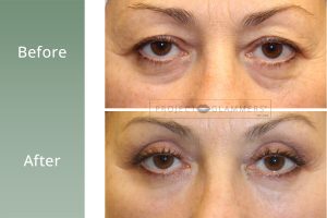 PG_BAs_Template_UnderEyeFiller