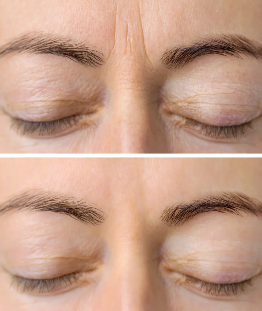Before and after results of Botox treatment on an older woman.