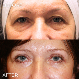 Upper Eyelid Lift Naples, FL