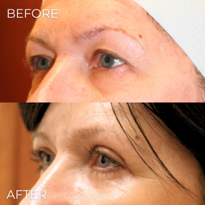 Upper Eyelid Lift Naples, FL