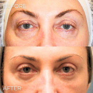 Upper Eyelid Lift Naples, FL