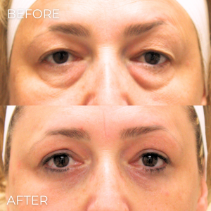 Upper Eyelid Lift Naples, FL