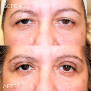 Upper Eyelid Lift Naples, FL