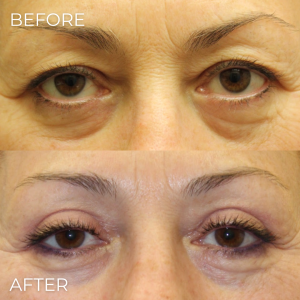 Upper Eyelid Lift Naples, FL