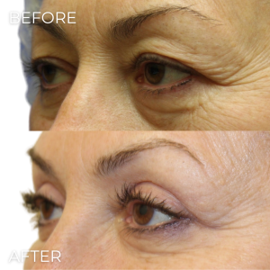 Upper Eyelid Lift Naples, FL