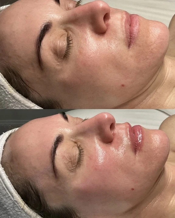Before and after facials treatment showing acne reduction.