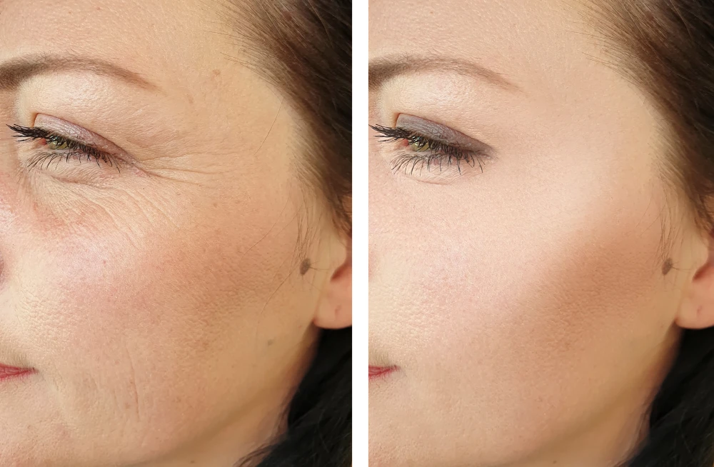 Before and after comparison showing wrinkle reduction with microneedling.