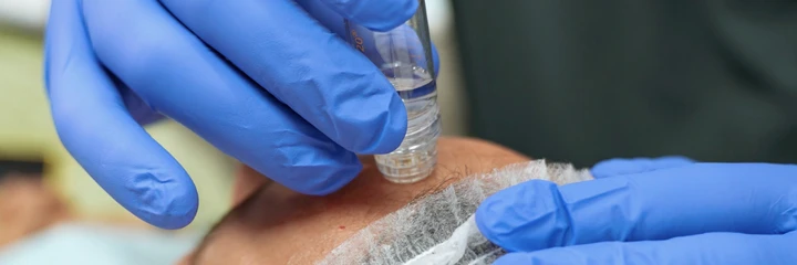 Man receiving professional microneedling treatment on face.